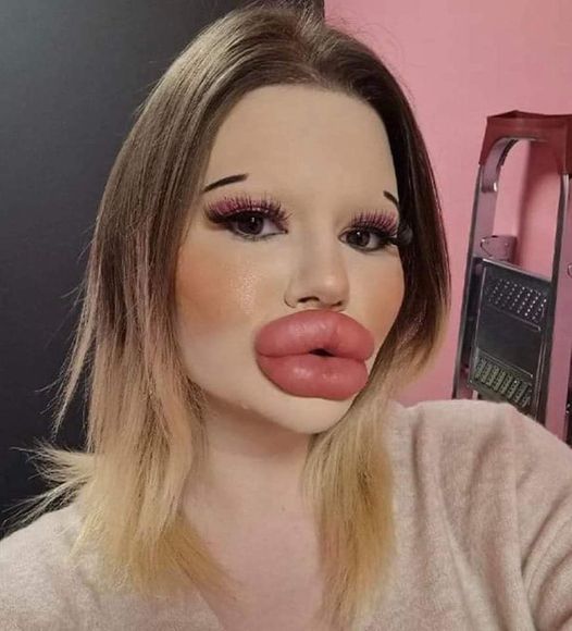 Young Woman Has 27 Procedures To Get The Biggest Lips In The World