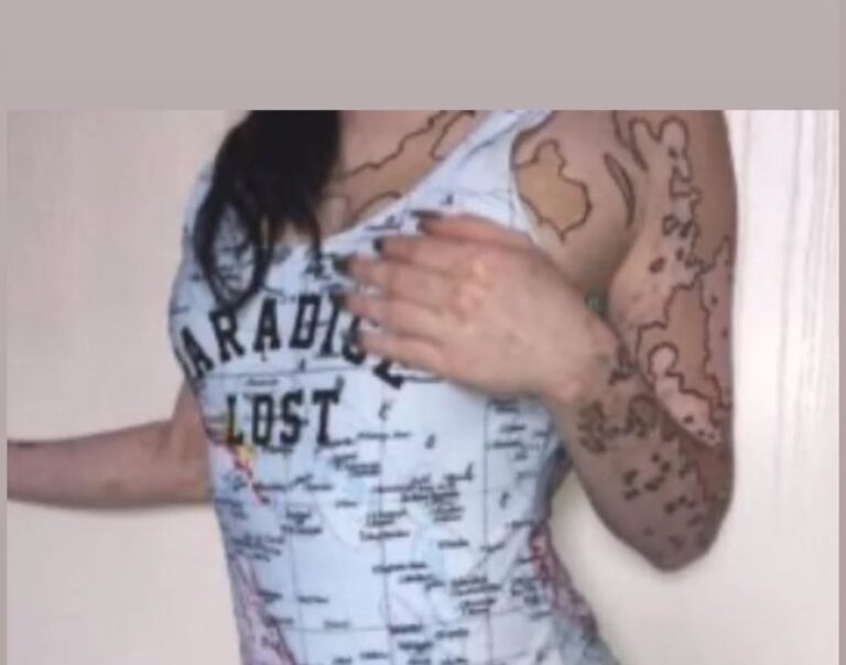 After Suffering ‘criticism’ For Vitiligo, This Girl Transformed Her Body Into Incredible Works Of Art.