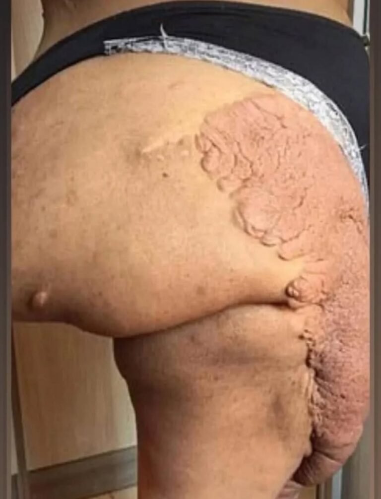 Neurofibroma: Understanding Its Origins, Signs, and Treatment Options