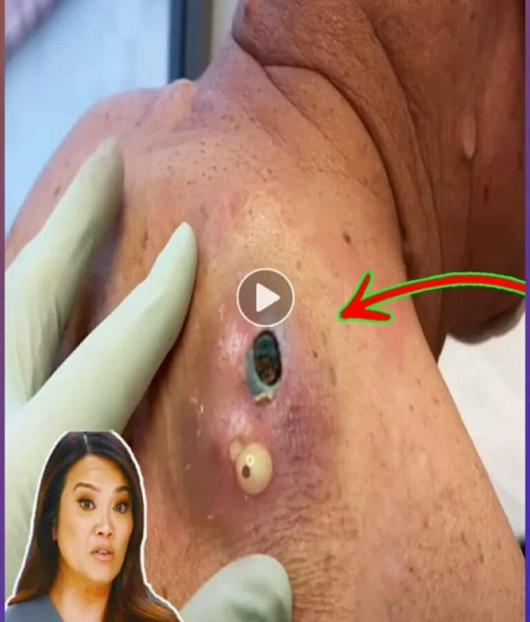 TLC’s Dr. Pimple Popper Shocks Viewers With One of Her Most Extreme Cases Yet