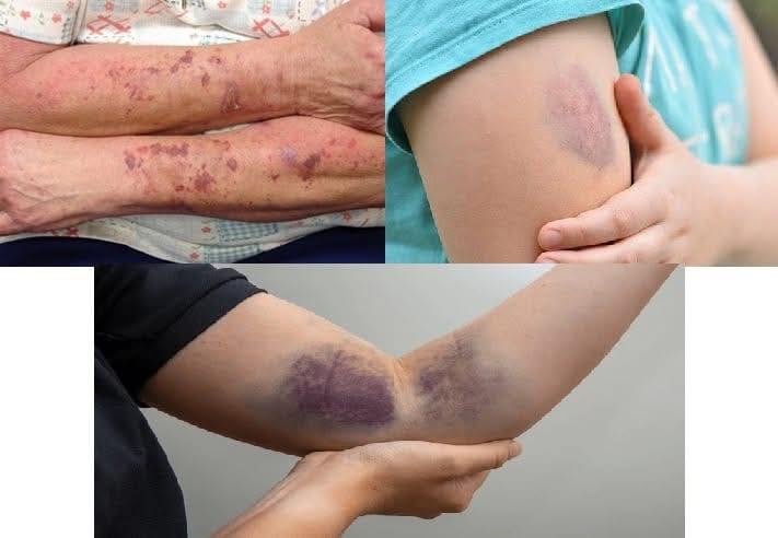 BE CAREFUL, if you get these bruises on your body, it means you have…