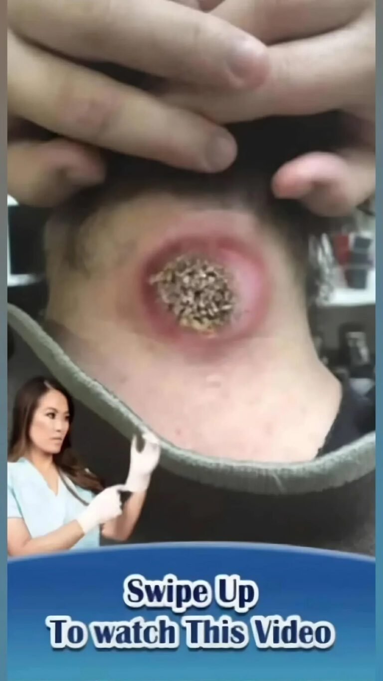 Medical Image of Neck Cyst Draws Public Attention